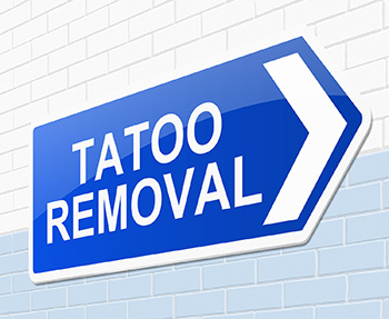 tattoo removal process